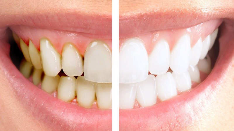 Как ухаживать за отбеленными зубами? 