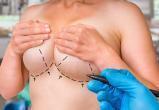 Популярная среди вологжанок операция по подтяжке груди стала доступнее