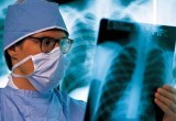 В Вологодской области стали реже умирать от туберкулеза