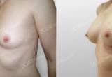 Врачи клиники «Константа» определили размер груди счастливых женщин