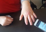 Подробности нашумевшей истории: вологжанка обвиняет медиков в том, что лишилась кончиков пальцев
