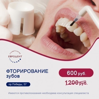 Фторирование зубов в Вологде со скидкой 50%