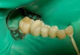 Что такое коффердам и как с его помощью лечат зубы?