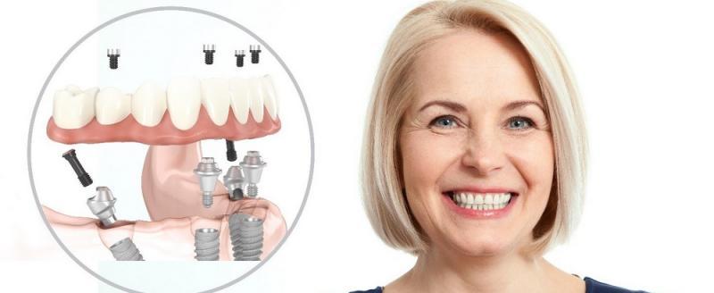 В стоматологии «Демократ» рассказали о преимуществах All-on-4 имплантации