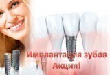 Имплантация «всё на 4-х» + несъемный протез одной челюсти от 9,5 тыс. рублей!