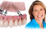 Имплантация «все на четырех» - это восстановление зубного ряда несъемным протезом