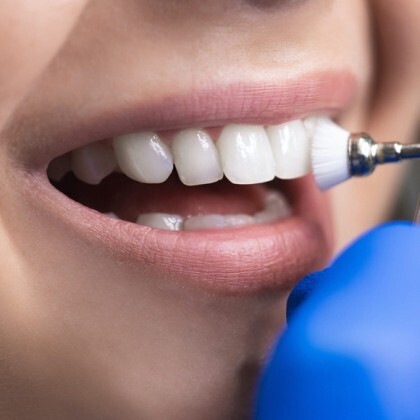 Профессиональная чистка зубов