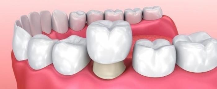 Сколько служат зубные коронки и когда их нужно менять