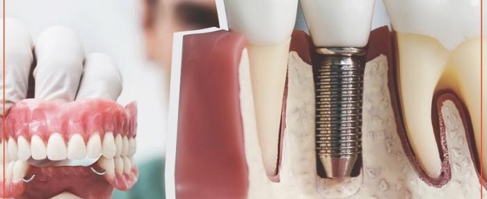 Когда лечение зуба нецелесообразно, то нужно брать курс на имплантацию!
