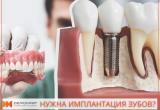 Когда лечение зуба нецелесообразно, то нужно брать курс на имплантацию!