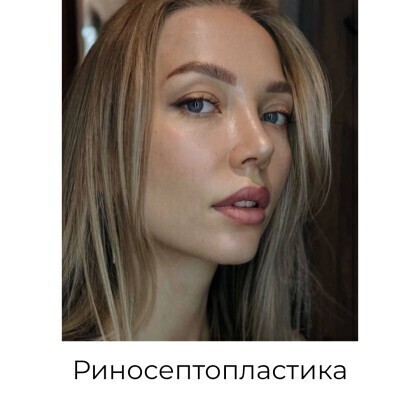 Ринопластика: пластика носа