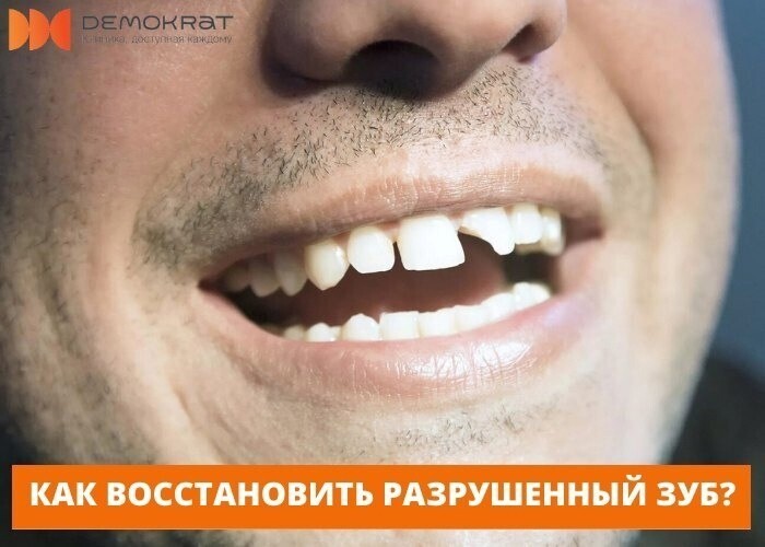 Восстановить разрушенные зубы всем пациентам готовы в клинике «Демократ»