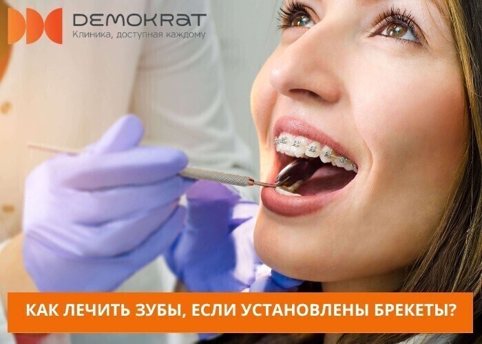 Важный вопрос: можно ли лечить зубы, когда установлены брекеты?