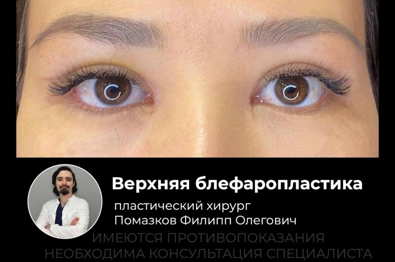 Блефаропластика творит чудеса, возвращая молодость и открытость вашему взгляду