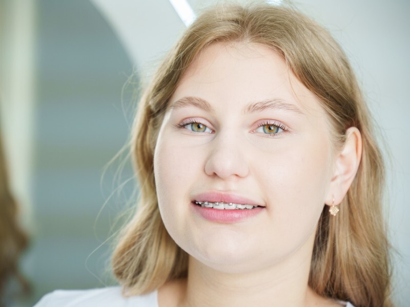 Брекеты во взрослом возрасте: развеиваем мифы и принимаем взвешенное решение