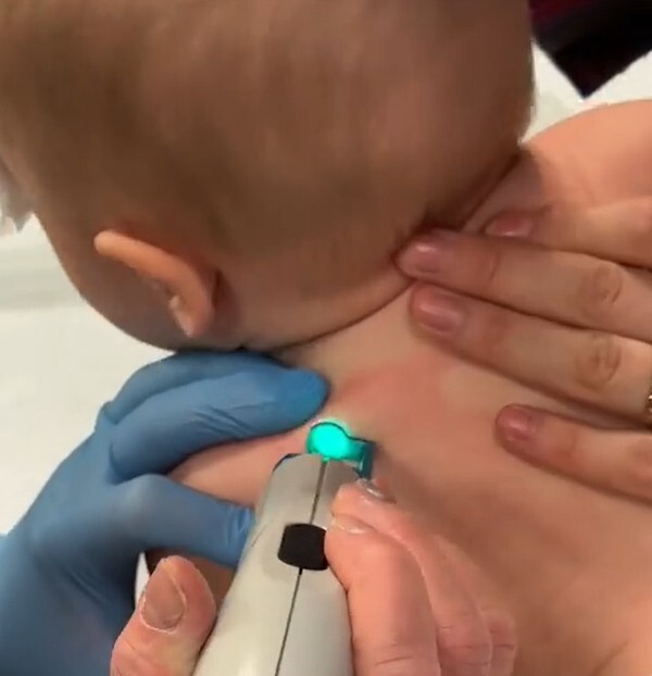 В клинике ОстМедКонсалт всегда готовы помочь ребенку с гемангиомой