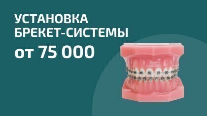 Установка брекет-системы от 75 000₽