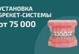 Установка брекет-системы от 75 000₽