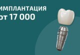 Имплантация с установкой от 17 000₽