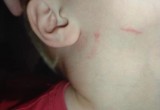 В частном детском саду в Вологде воспитательница заперла ребенка в туалете и расцарапала ему лицо