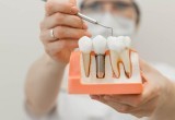 Выгодная имплантация зубов в стоматологии «Демократ»